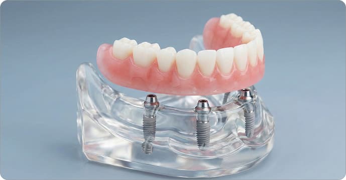 Overdentures Vancouver