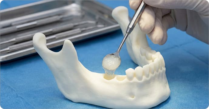 Bone Grafting Ridge Preservation Vancouver