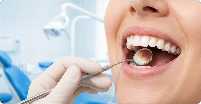 Cracked Tooth Repair Vancouver