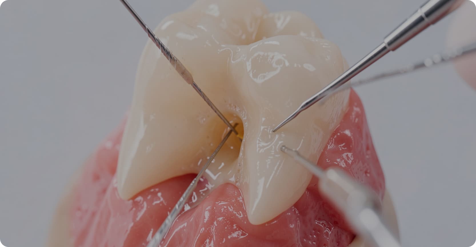 Root Canal Therapy Vancouver